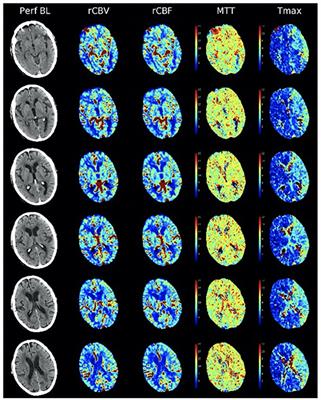 Precision Medicine for Intracranial Atherosclerotic Disease